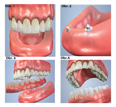 implantáty